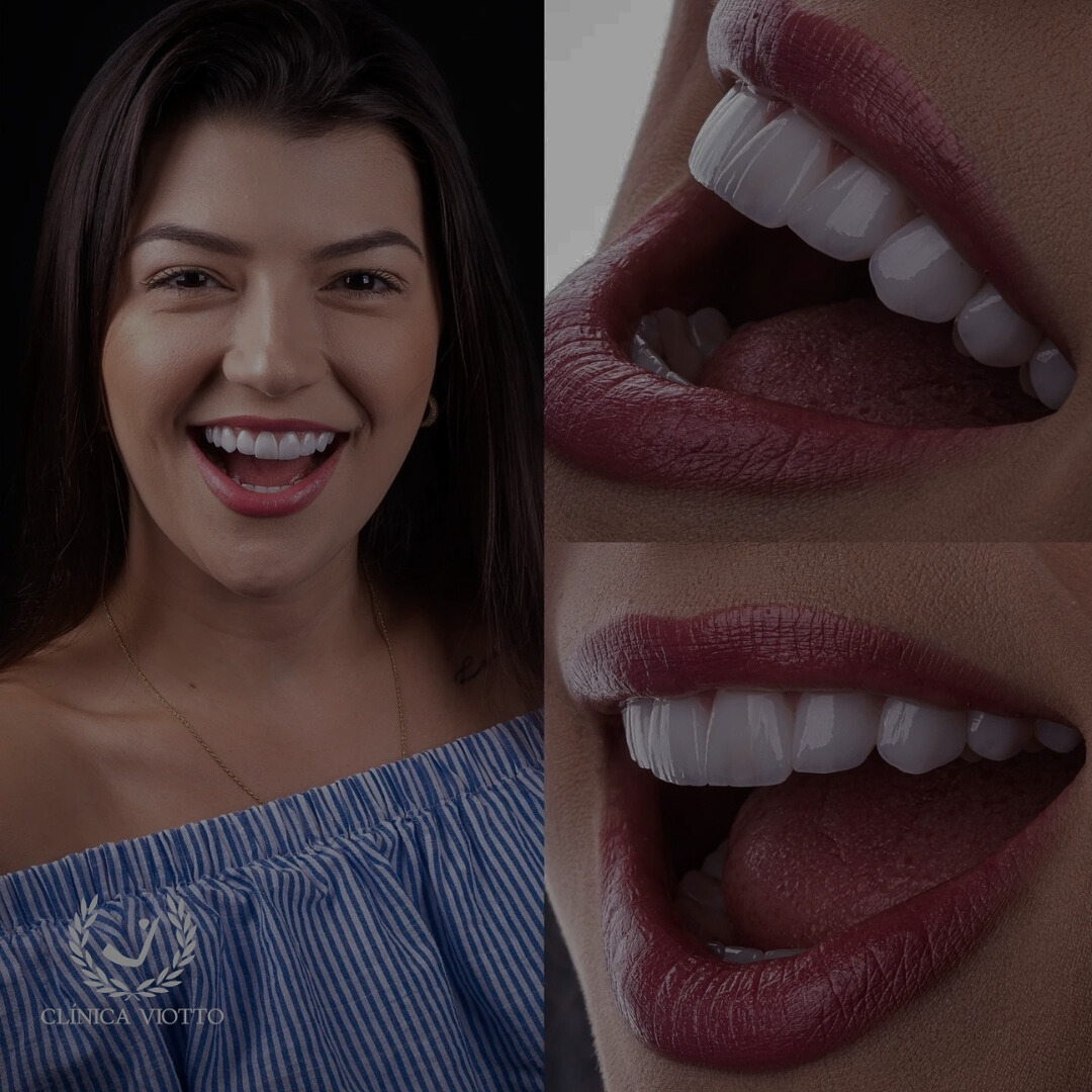 Mais um sorriso totalmente transformado com as Lentes de Contato Dental Padrão Viotto!! ...........#LentedeContatoDental #SorrisoViotto....Realizando sonhos em Goiânia! .. (62) 9 9518-1430... R. 144, 101 (3)