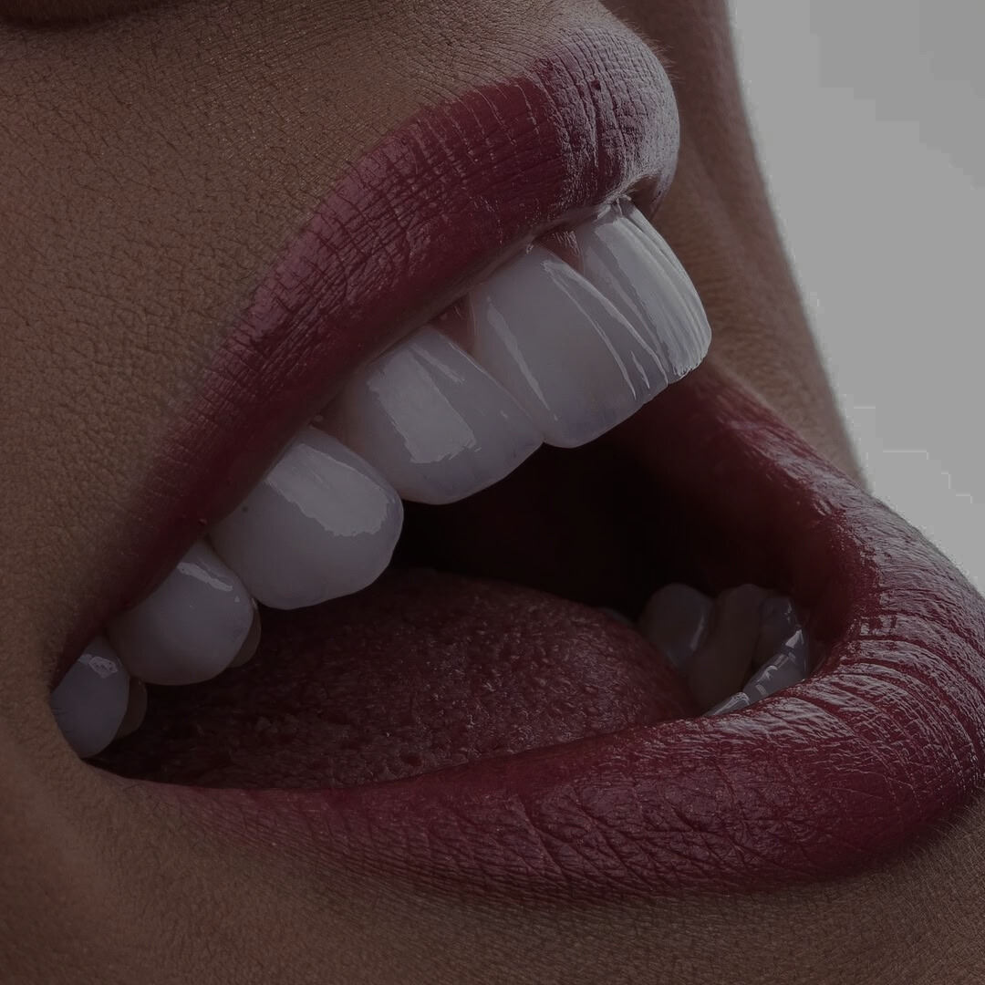 Mais um sorriso totalmente transformado com as Lentes de Contato Dental Padrão Viotto!! ...........#LentedeContatoDental #SorrisoViotto....Realizando sonhos em Goiânia! .. (62) 9 9518-1430... R. 144, 101 (4)